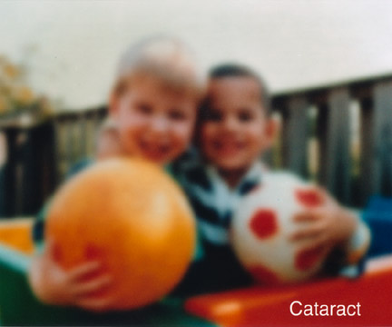 cataracts vision